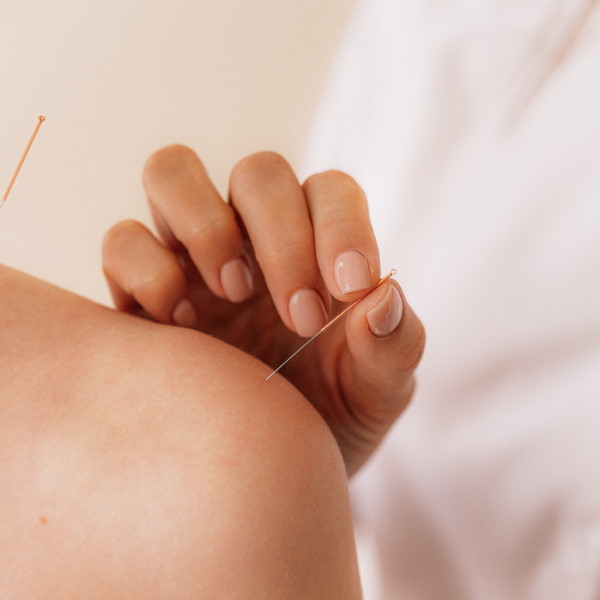 Acupuncturist putting needles on the shoulder of a person. Jenna Robins provides Acupuncture in Wilmslow.