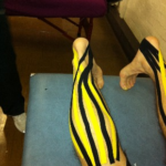 Sports Rehab Kinesio-Acu Taping. Acupuncture in Cheshire.